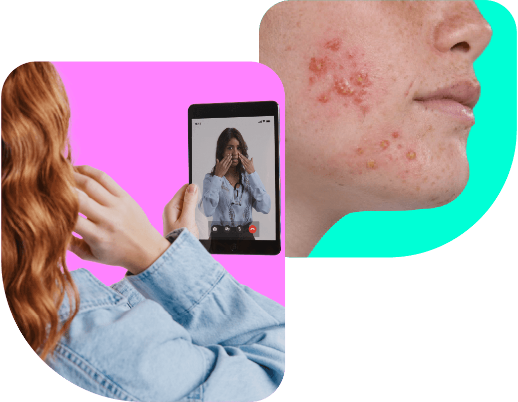 Acne Treatment